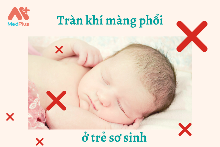 Triệu chứng tràn khí màng phổi thứ phát ở trẻ sơ sinh