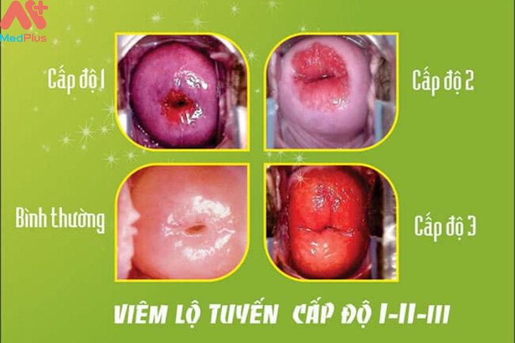 Cách điều trị hiệu quả cho bệnh viêm lộ tuyến cổ tử cung ở giai đoạn 2
