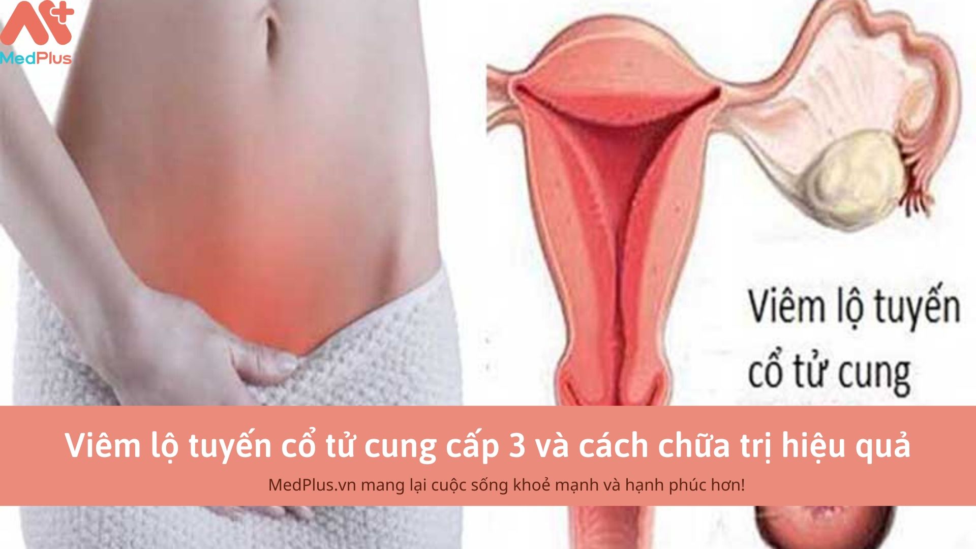 Viêm lộ tuyến cổ tử cung cấp 3 và cách chữa trị hiệu quả