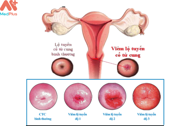 Cách điều trị hiệu quả cho bệnh viêm lộ tuyến cổ tử cung ở giai đoạn 3