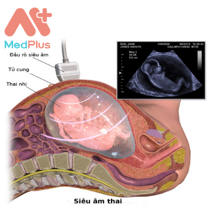 Siêu âm thai phát hiện dị tật