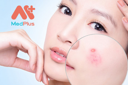 Bật mí Top 5 cơ sở trị mụn trứng cá hàng đầu Quận 1 - Medplus