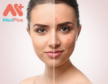 Bật mí Top 5 cơ sở trị thâm mụn hàng đầu TPHCM 132 Bật mí Top 5 cơ sở trị thâm mụn hàng đầu TPHCM