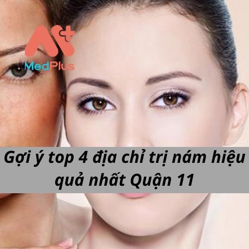 Gợi ý top 4 địa chỉ trị nám hiệu quả nhất Quận 11
