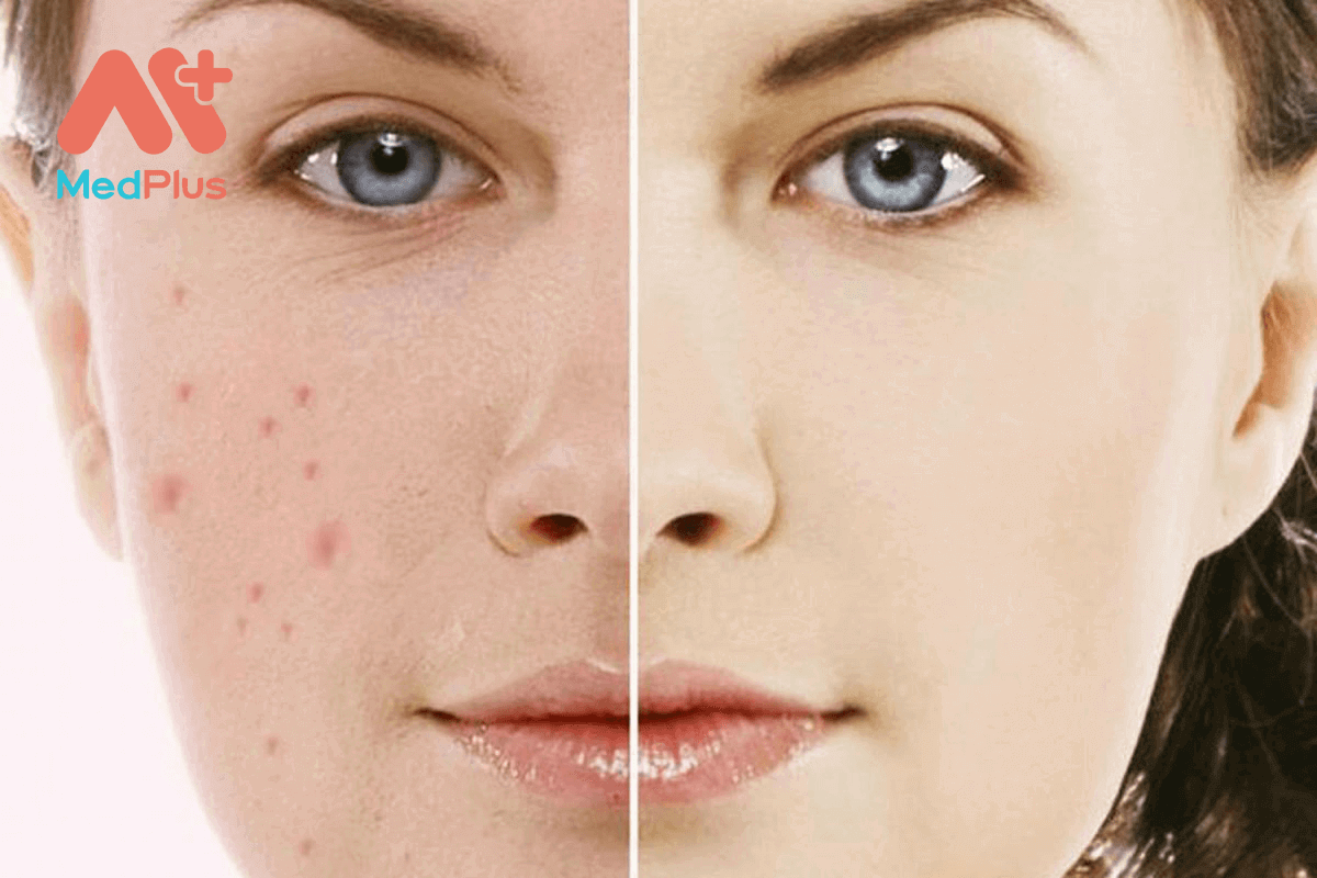 trị thâm mụn uy tín