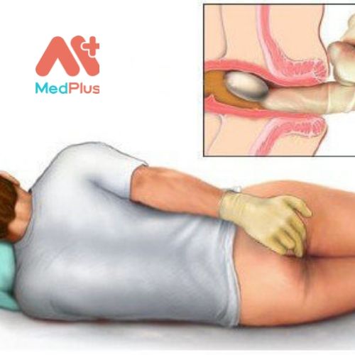 Tìm hiểu 5 địa chỉ khám bệnh trĩ uy tín nhất Quận 12