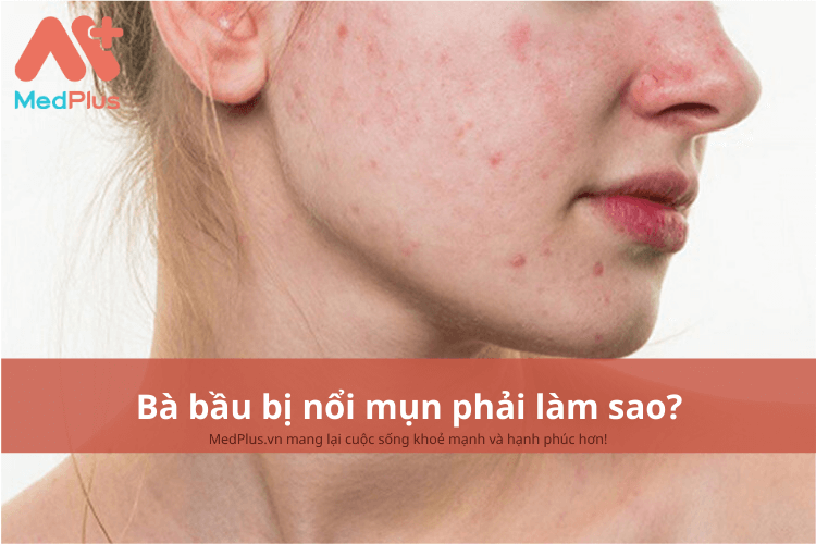 Bà bầu bị nổi mụn phải làm sao