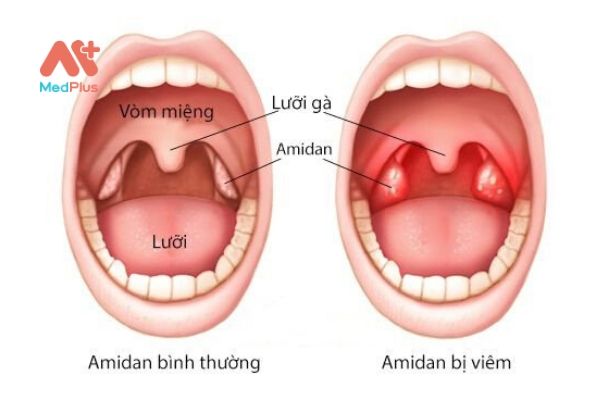 Amidan và tình trạng viêm amidan