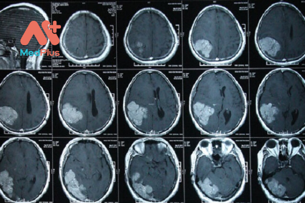 Chụp CT não