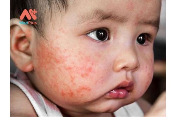 TOP 6+ thuốc trị chàm hiệu quả và an toàn năm 2020 134 Chứng chàm sữa xảy ra ở trẻ em