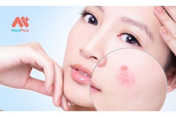 Mụn trứng cá gây cảm giác khó chịu và mưng mủ