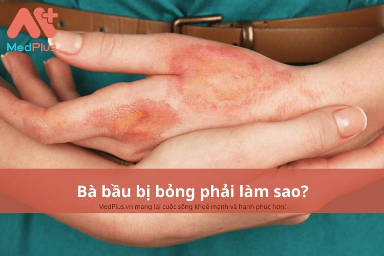 Bà bầu bị bỏng phải làm sao