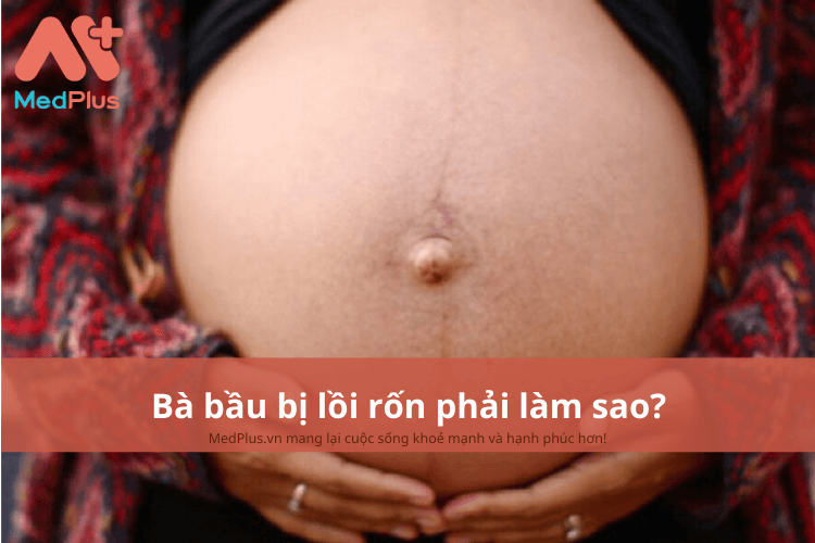 Bà bầu bị lồi rốn phải làm sao? Có ảnh hưởng đến thai nhi không? 2 Phụ nữ mang thai bị lồi rốn phải làm sao?