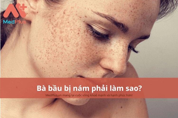 Bà bầu bị nám phải làm sao