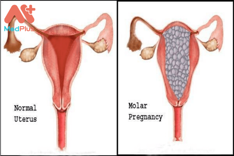 Bà bầu bị thai trứng phải làm sao?
