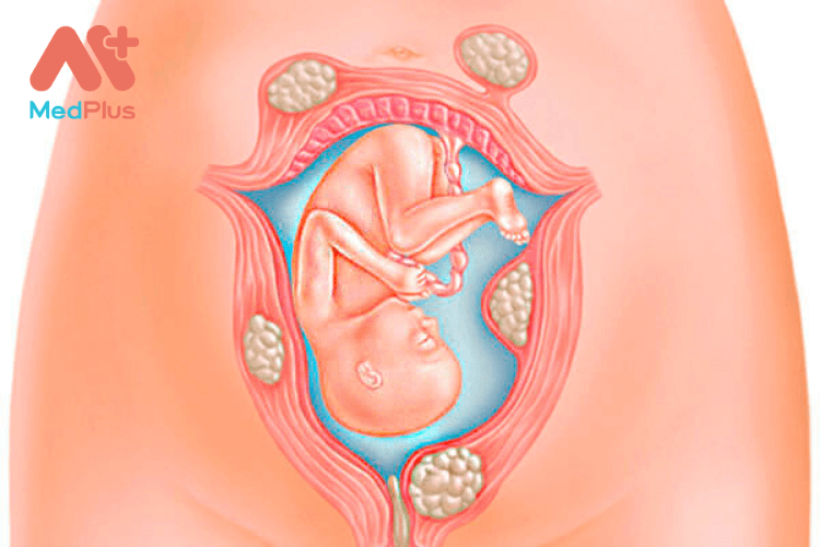 U xơ tử cung khi mang thai