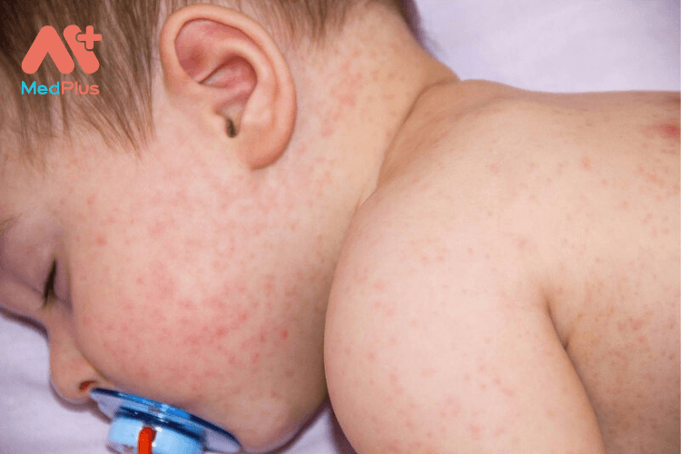 Trẻ sơ sinh bị sốt xuất huyết có sao không?