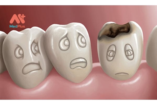 Đừng để sâu răng ảnh hưởng đến cuộc sống và sức khỏe của bạn!