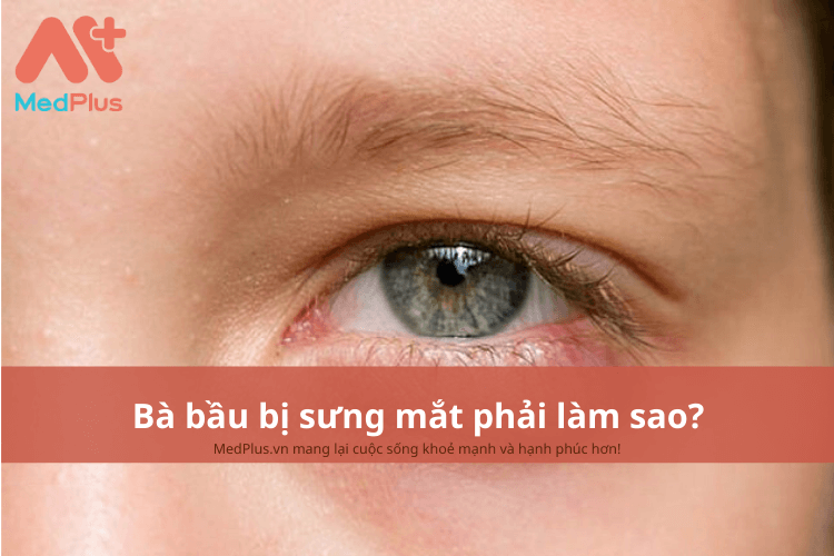 Bà bầu nên chăm sóc như thế nào khi bị sưng mí mắt?
