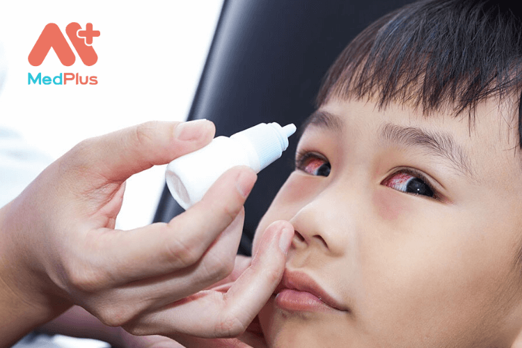 Cách chăm sóc trẻ nhỏ bị đau mắt đỏ