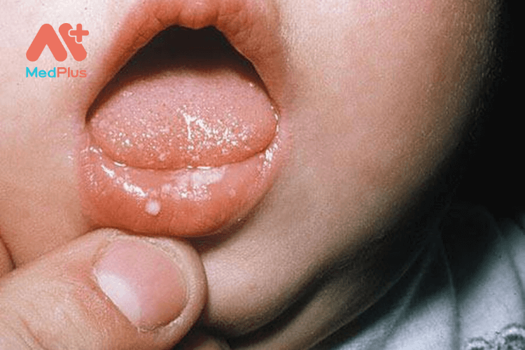 Những triệu chứng thường gặp ở trẻ bị nhiệt miệng