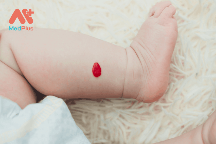 Trẻ sơ sinh bị u máu có nguy hiểm không?