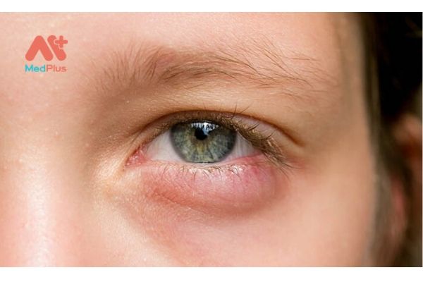 Làm sao để điều trị lẹo mắt?