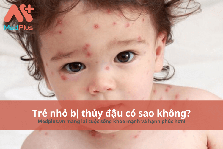 Trẻ nhỏ bị thủy đậu có sao không