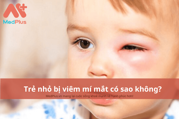 Trẻ nhỏ bị viêm mí mắt có sao không?