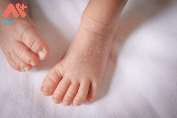 Trẻ sơ sinh bị khô da có sao không?
