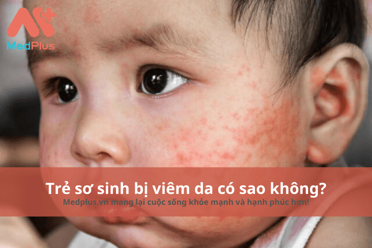 Trẻ sơ sinh bị viêm da có sao không? – Những điều bố mẹ cần biết 2 Trẻ sơ sinh bị viêm da có sao không