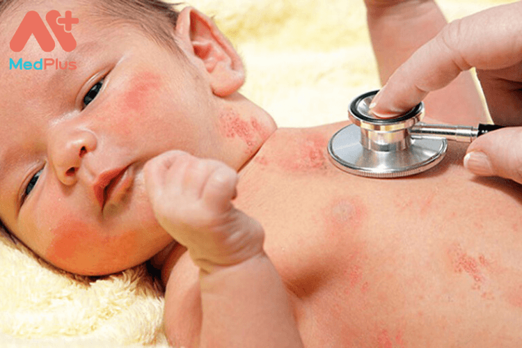 Trẻ sơ sinh bị viêm da có sao không? – Những điều bố mẹ cần biết 128 Trẻ sơ sinh bị viêm da phải làm sao