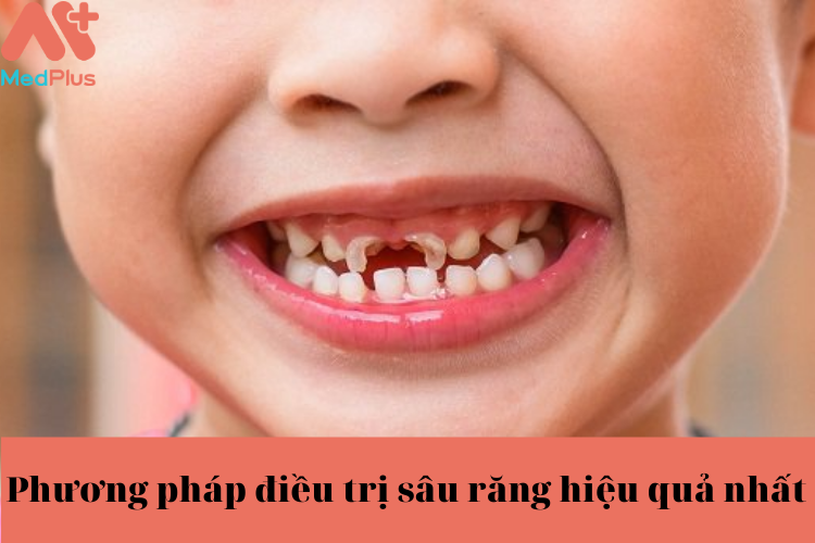 Benh sau rang - Medplus