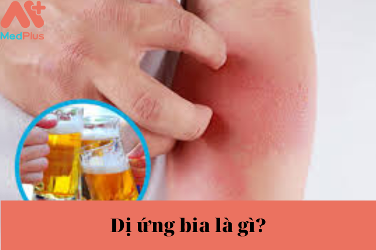 Dị ứng bia