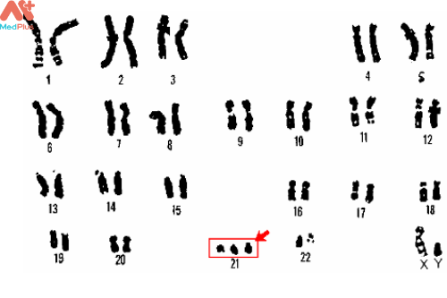 Dư một nhiễm sắc thể 21