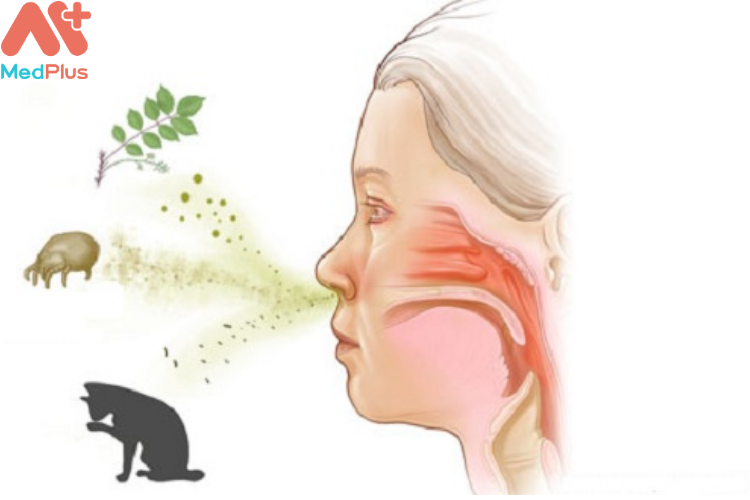 Bệnh viêm mũi dị ứng