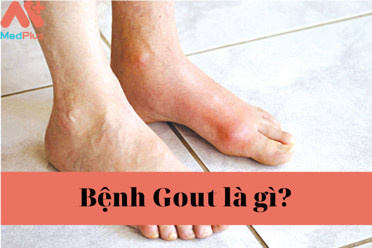 benh gout - Medplus