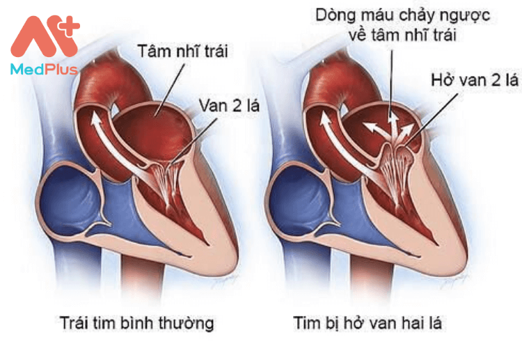 Bệnh van tim thường biểu hiện dưới hai dạng tổn thương chính là hẹp van tim và hở van tim.