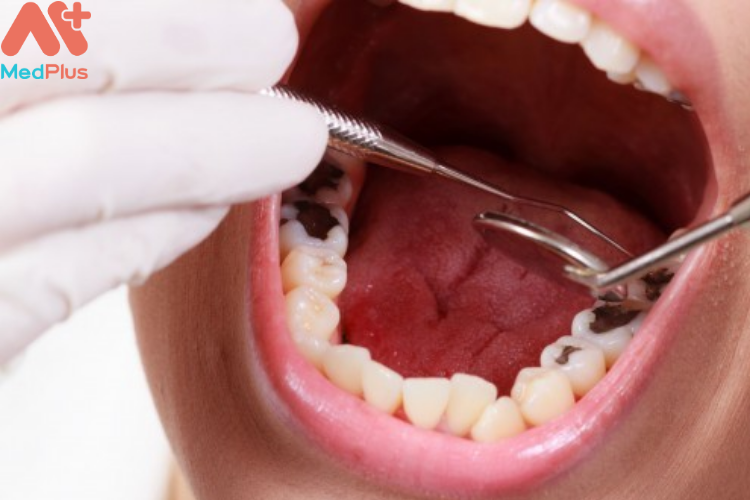 Các phương pháp điều trị sâu răng