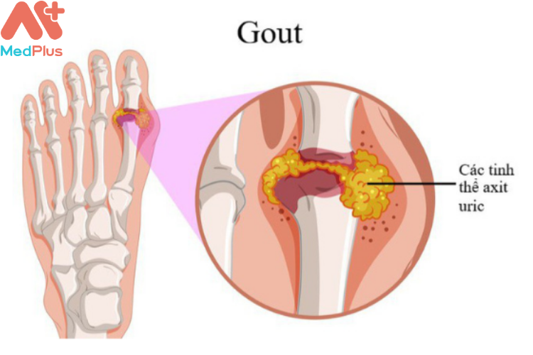 Bệnh gout là do axit uric dư thừa