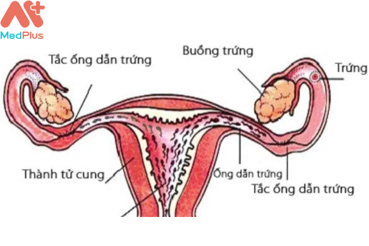 Nguyên nhân dẫn đến vô sinh ở nữ