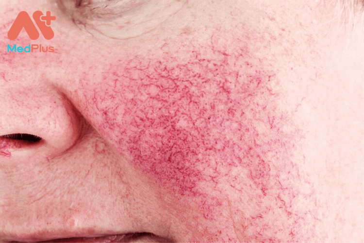 triệu chứng của bệnh rosacea có thể phát triển trên mặt và các vùng lân cận như cổ, ngực và tai.