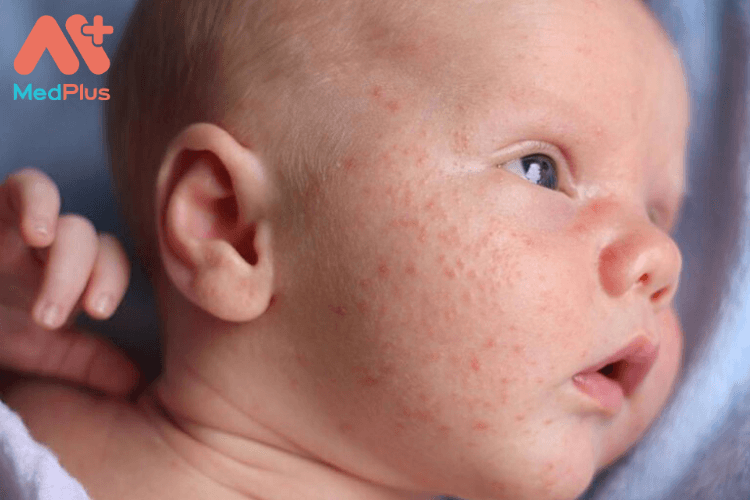 Trẻ nhỏ bị chàm đỏ có sao không? – Những điều bố mẹ cần biết 128 Trẻ nhỏ bị chàm đỏ phải là sao