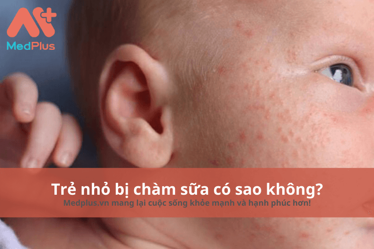 Trẻ nhỏ bị chàm sữa có sao không