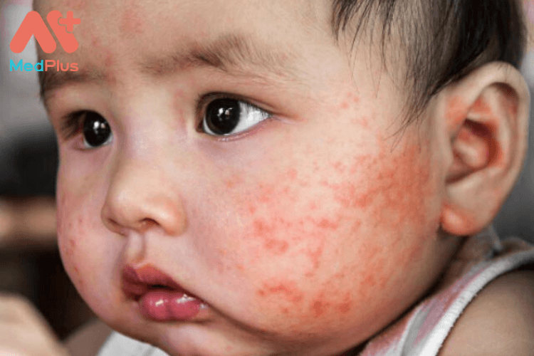 Trẻ nhỏ bị chàm sữa phải làm sao