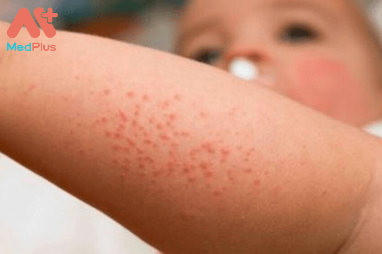 Trẻ nhỏ bị dị ứng hải sản có sao không? Những điều bố mẹ cần biết 128 Trẻ nhỏ bị dị ứng hải sản có sao không?