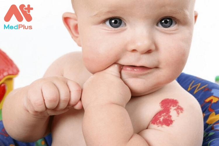 Trẻ nhỏ bị u máu phải làm sao