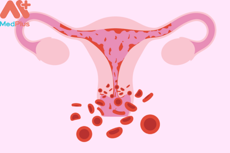 Căn bệnh ung thư cổ tử cung là do các tế bào bất thường ở cổ tử cung ( phần dưới của tử cung) phát hiện vượt quá mức kiểm soát của cơ thể gây ra.Các tế bào mới này phát triển quá nhanh chóng và tạo ra khối u cổ tử cung