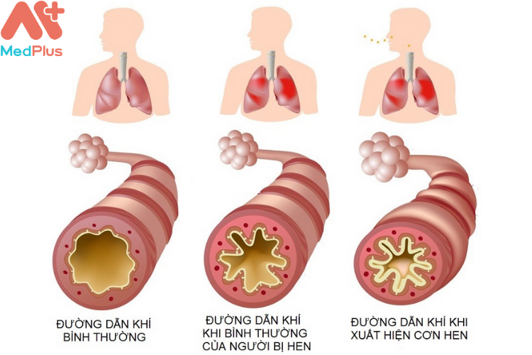 Hen suyễn - Hen phế quản là bệnh gì?