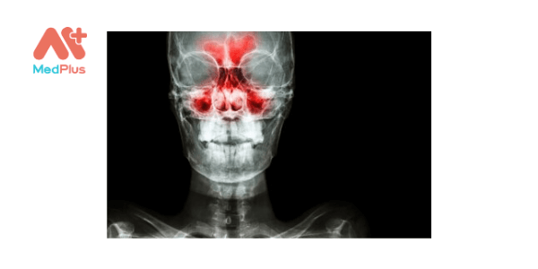 Bệnh Viêm xoang gây đau nhức cả vùng mũi, trán và đau đầu.